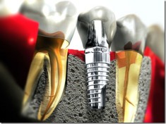 Implante Dentario - Foto do Artigo